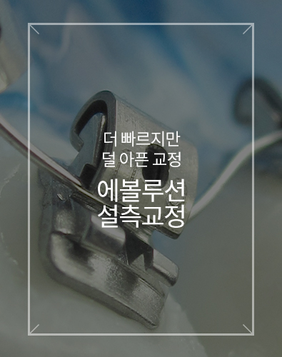 에볼루션 설측교정