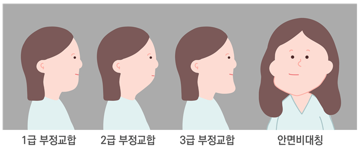 무턱교정